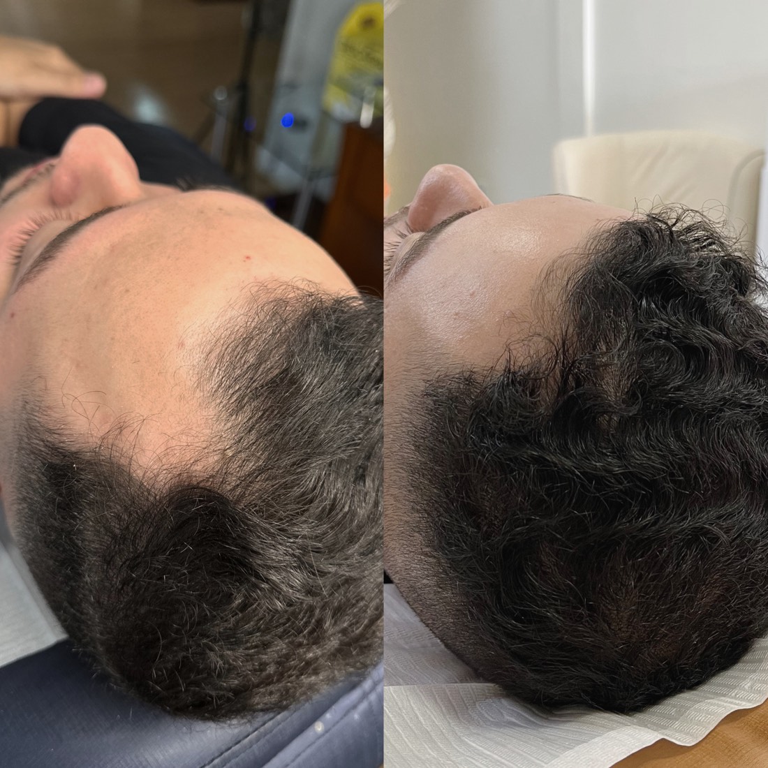 Antes e depois — recuperação capilar no Instituto MV