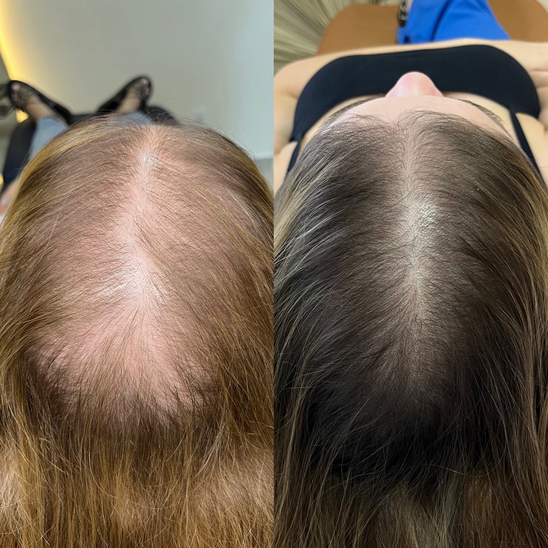 Antes e depois — recuperação capilar no Instituto MV